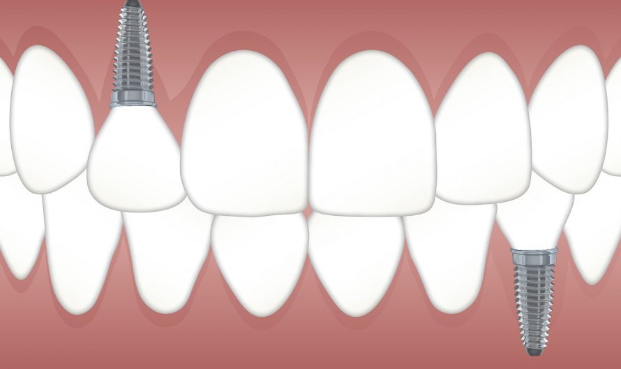Implantes dentales: todo lo que necesita saber