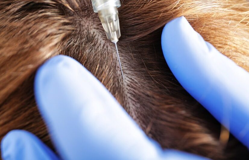 Cirugía de injerto capilar: El mejor trasplante de pelo en Zaragoza